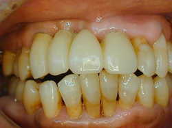 歯周病の症状のページで紹介した70歳代女性の治療後の写真